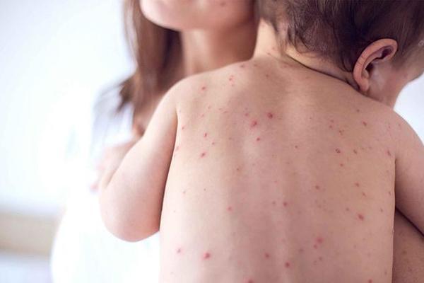 На Россию напали корь и грипп H1N1. 54441.jpeg На Россию напали корь и грипп H1N1. 54441.jpeg