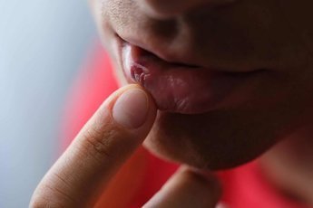 Простые методы лечения порезанной губы дома