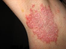 Взгляд на болезнь Хейли: Редкое заболевание кожи