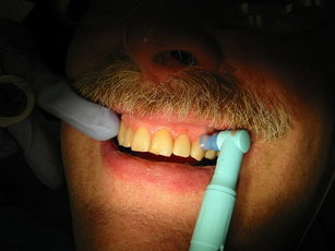 Домашние отбеливатели для зубов DIY: либо полировка, либо химия