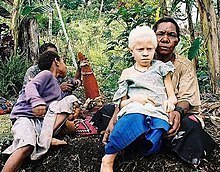 Что такое альбинизм