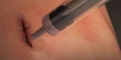 Исследователи создали хирургический клей, который затягивает раны за одну минуту
