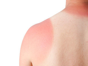 Легкие и естественные способы лечения солнечных ожогов и ухода за кожей в домашних условиях