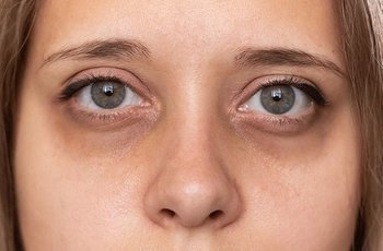 Серьезные проблемы со здоровьем, которые могут вызывать темные круги под глазами