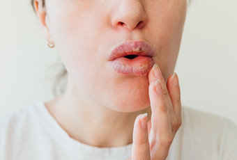 Эффективные домашние средства для лечения отекшей губы