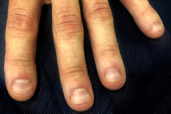 Странные проблемы с ногтями, и что они говорят о вашем здоровье