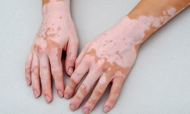 Натуральные средства, которые борются с витилиго и защищают вашу кожу