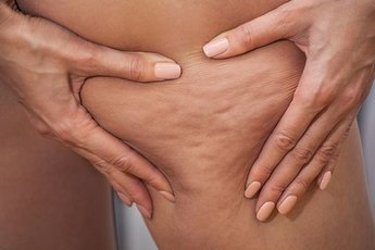 Как быстро и эффективно избавиться от целлюлита